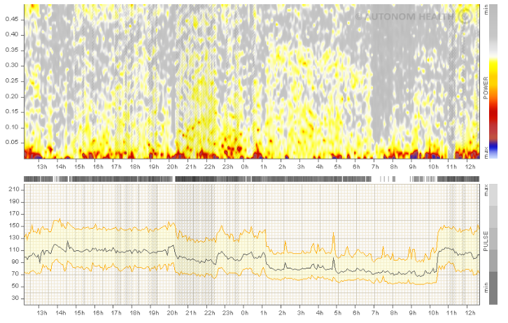 Klicke auf die Grafik fÃÂ¼r eine vergrÃÂ¶ÃÂerte Ansicht  Name: HerzrhythmusstÃÂ¶rungen im HRV Spektrogramm.png Ansichten: 0 GrÃÂ¶ÃÂe: 388,0 KB ID: 3426